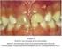 PALAVRAS-CHAVE: Dente decíduo; Cimentos de ionômero de vidro; Infiltração dentária.