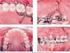 INTRUSÃO ORTODÔNTICA NO TRATAMENTO DE DENTES COM COMPROMETIMENTO PERIODONTAL ORTHODONTIC INTRUSION IN THE TREATMENT OF TEETH COMMITMENT TO PERIODONTAL