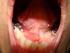 Sialolito no ducto da glândula submandibular: relato de caso