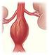 Tratamento endovascular dos aneurismas de aorta abdominal: experiência inicial e resultados a curto e médio prazo