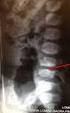 Tuberculose óssea na coluna vertebral: aspectos clínicos e cirúrgicos Vertebral tuberculosis of the spine: clinical aspects and surgery