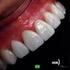 E.max como fator estético na reabilitação em dentes com coroas clínicas curtas: relato de caso clínico