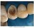 Materiais utilizados no tratamento das perfurações endodônticas Materials used in the treatment of endodontic perforations