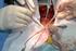 Estado atual da cirurgia de revascularização do miocárdio. Coronary artery bypass graft: state of the art