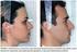 Estudo comparativo do perfil facial de indivíduos Padrões I, II e III portadores de selamento labial passivo