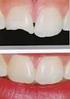 Efeito de adesivos na união entre dentes artificiais e resinas acrílicas termopolimerizáveis*
