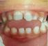 Maloclusões e traumatismos dentários em escolares de seis a doze anos de idade: estudo piloto