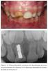 Resistência à Fratura de Dentes Reforçados com Pinos Pré-fabricados, Utilizando Diferentes Agentes Cimentantes.