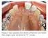 Distinção entre Dois Tipos de Lesão Dentinária na Superfície Oclusal sob Esmalte sem Cavitação