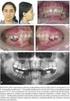 Hipodontia de dentes permanentes: prevalência e distribuição numa População Brasileira