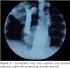Aspectos tomográficos da tuberculose pulmonar em pacientes adultos com AIDS *