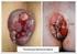 Complicações Pós-Operatórias Cirúrgicas da Hemorroidectomia: Revisão de 76 Casos de Complicações