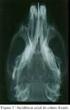 Estudo radiográfico do crescimento mandibular e dos ossos da mão e do carpo. Radiographic study of the carpal bones and mandible growth