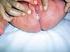 Hiperplasia congénita da suprarrenal no período neonatal