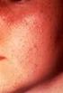 L Acne vulgar L Acne conglobata L Outras formas de acne. Isotretinoina 10 mg (por cápsula) 2. Acne