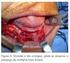 Cisto periapical residual tratado por descompressão: relato de caso clínico-cirúrgico