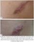 Uso de bleomicina em queloides e cicatrizes hipertróficas: revisão da literatura