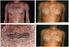 Resultados do tratamento das cicatrizes queloideanas com cirurgia e imiquimode 5% creme: um estudo prospectivo