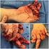 Trauma complexo da mão parte I: lesão vascular, lesão nervosa, lesão tendínea