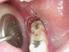 Dor pós-operatória em dentes com infecções