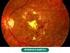 Retinopatia Diabética: