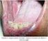 Líquen Plano Oral em Lábio Inferior: Relato de Caso Oral Lichen Planus in the Lower Lip: A Case Report