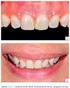Estabilidade de cor de cerâmica odontológica após glaze e polimento Color stability of dental ceramics after glaze and polishing
