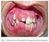 Odontodisplasia Regional: Relato de um Caso Clínico
