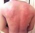 Prevalência de eczema atópico e sintomas relacionados entre estudantes