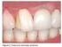 Resistência à fratura de restaurações diretas com cobertura de cúspide em pré-molares superiores endodonticamente tratados