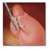Laparoscopic treatment of gastroesophageal reflux disease