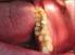 ORIGINAL ARTICLE. Traumatic bone cyst of the mandible: a review of 26 cases. Cisto ósseo traumático da mandíbula: revisão de 26 casos
