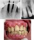Abordagem cirúrgico-ortodôntica de dentes não irrompidos