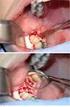 Tratamento cirúrgico radical de terceiro e quarto molares fusionados: Relato de caso