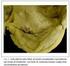 Caso I: Valvulotomia por balão de estenose mitral Dr. J oberto Joberto Sena Cardiologista Intervencionista do HSI Diarista UCV do HSI