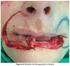 Reconstrução do lábio inferior com retalhos de Karapandzic e Gilles após excisão de carcinoma espinocelular