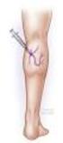 Varicose veins surgery of lower limbs. Can we preserve great saphenous vein?