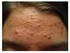 Tratamento da acne vulgar moderada a grave com isotretinoína oral similar ao produto