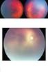 Comparação da Eficácia entre Bevacizumab e Ranibizumab no Edema Macular Associado à Oclusão Venosa da Retina