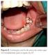 TRANSPLANTE DENTÁRIO AUTÓGENO: APRESENTAÇÃO DE DOIS CASOS. Autologous dental transplantation: report of two cases