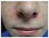 Administração oral melhora os sintomas da dermatite atópica em crianças e reduz a necessidade de corticosteróides tópicos.