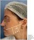 Afinamento do terço inferior da face com uso de toxina botulínica no músculo masseter