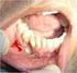 Cisto odontogênico ortoqueratinizado x tumor odontogênico queratocístico: a importância da diferenciação histopatológica no tratamento