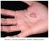 Tumores da mão parte I: tumores de partes moles da mão