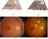 Automatic Detection of Glaucoma Using Disc Optic Segmentation and Feature Extraction