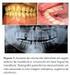 Odontoma complexo associado a cisto dentígero: relato de dois casos clínicos. Complex odontoma associated with dentigerous cyst: a report of two cases