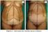 Abdominoplastia circunferencial após grande perda ponderal