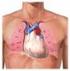 Hipertensão Pulmonar Primária