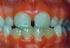 Prevalência de defeitos do esmalte em dentes decíduos de crianças nascidas prematuras