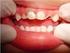 Prevalência de fluorose dentária em escolares de 12 anos de idade, Ouro Preto/MG 2003